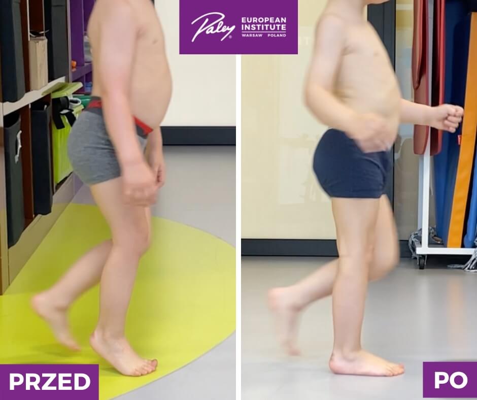 Skrócenie mięśnia